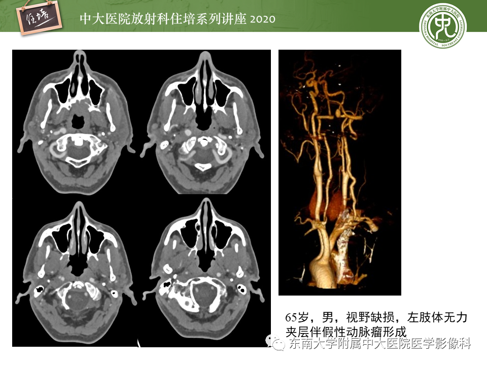 【PPT】颈动脉夹层及夹层动脉瘤的影像诊断及评估