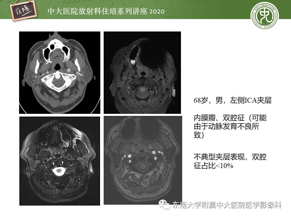 【PPT】颈动脉夹层及夹层动脉瘤的影像诊断及评估