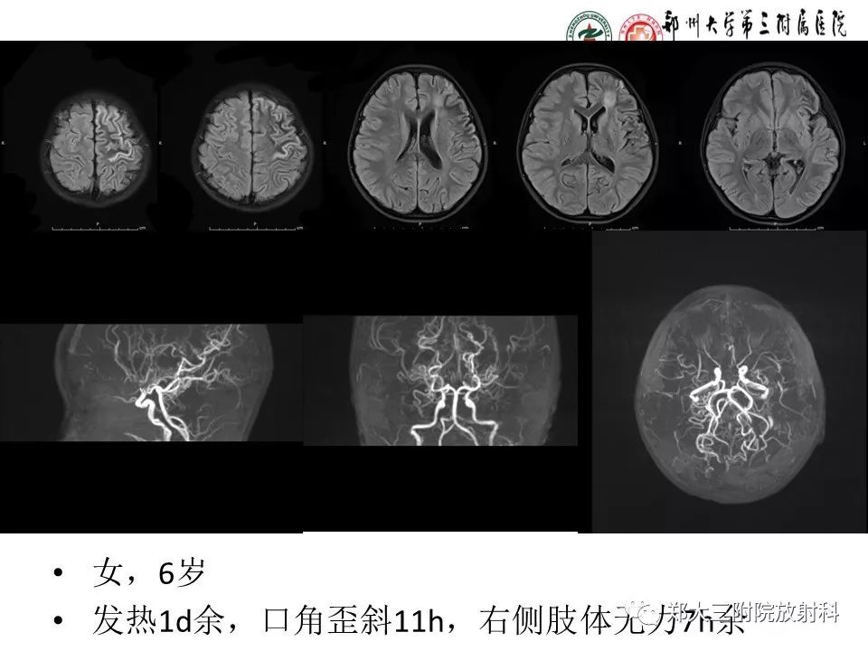 【PPT】烟雾病的影像诊断