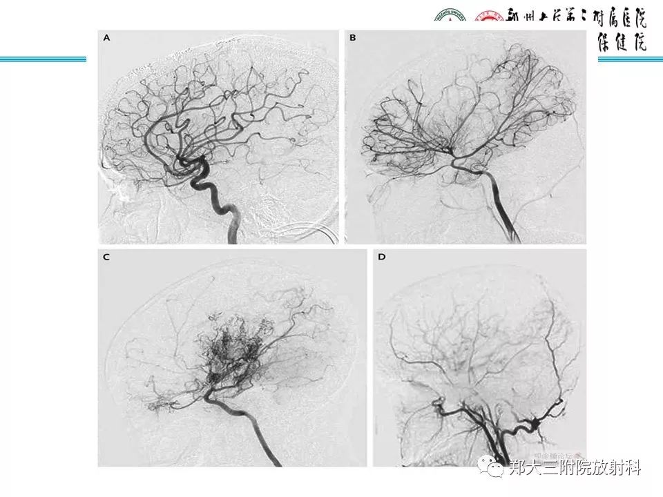 【PPT】烟雾病的影像诊断