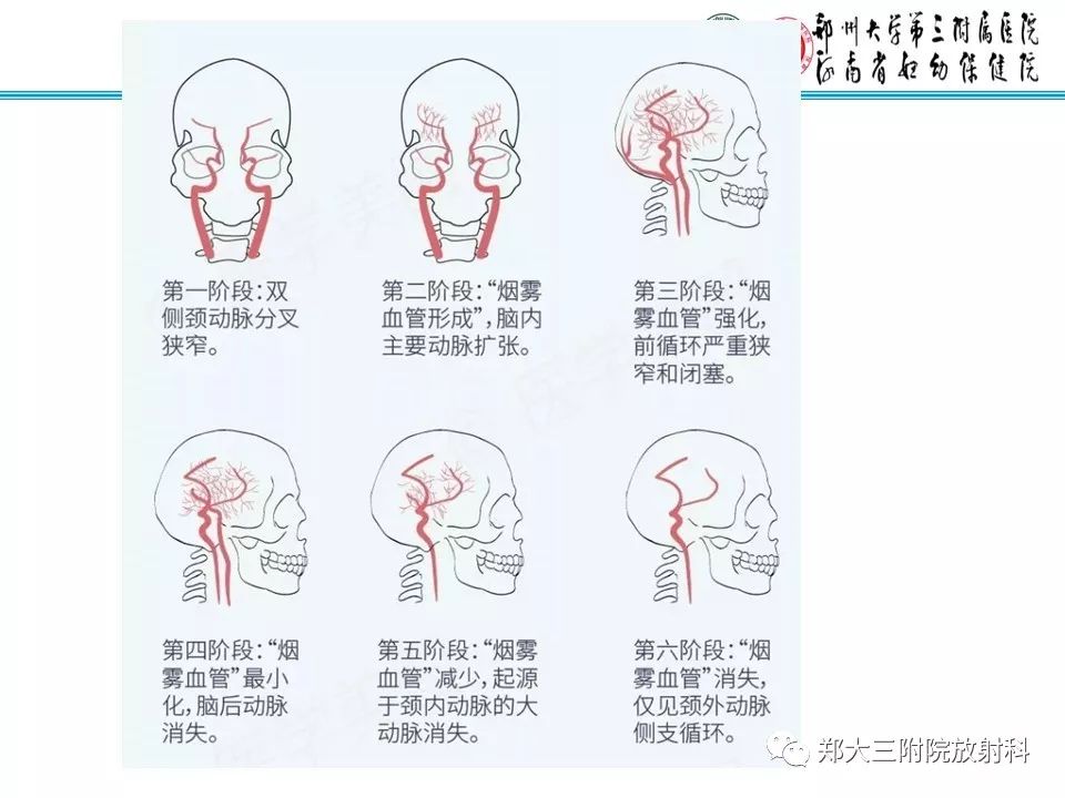 【PPT】烟雾病的影像诊断