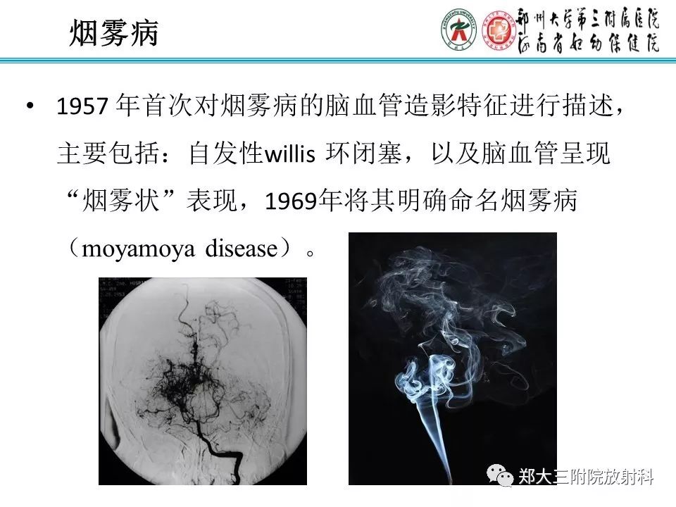 【PPT】烟雾病的影像诊断