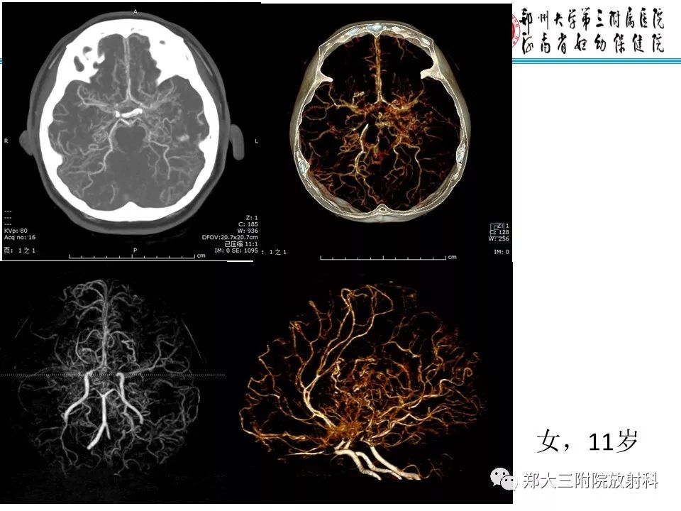 【PPT】烟雾病的影像诊断