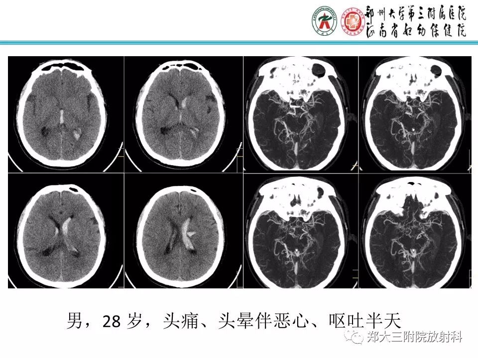 【PPT】烟雾病的影像诊断