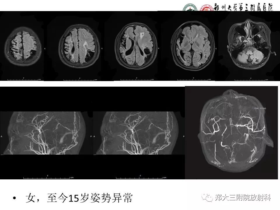 【PPT】烟雾病的影像诊断