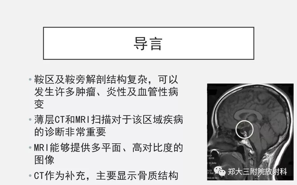 【PPT】垂体增生的影像表现