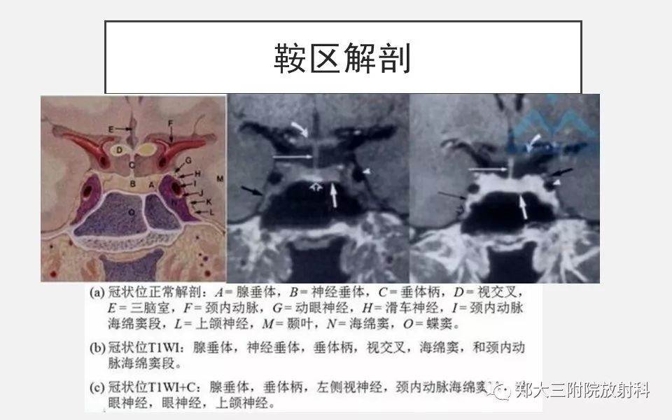 【PPT】垂体增生的影像表现