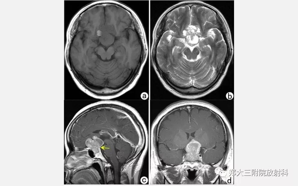 【PPT】垂体增生的影像表现