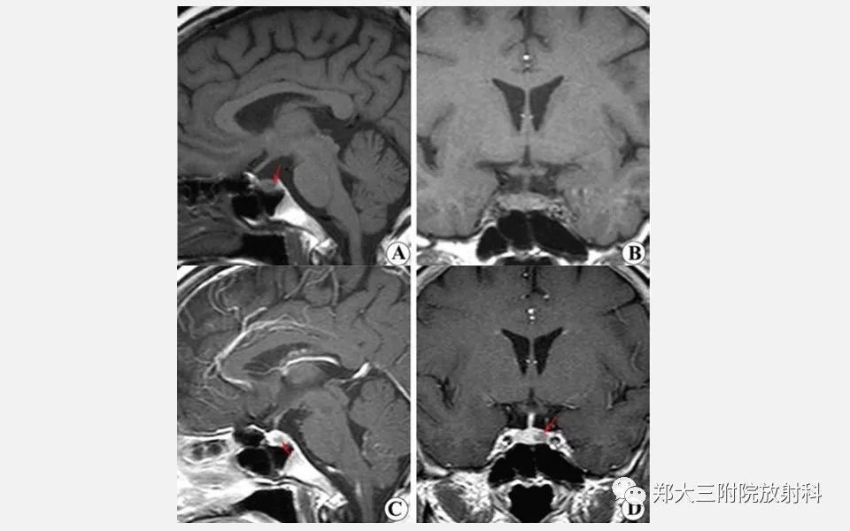 【PPT】垂体增生的影像表现