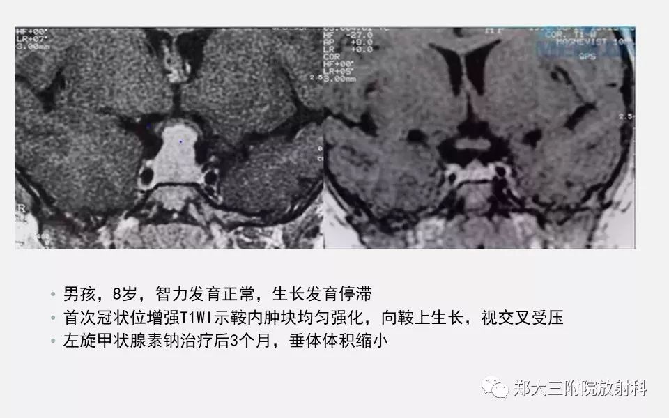 【PPT】垂体增生的影像表现