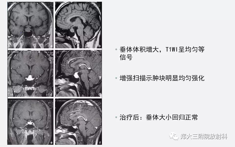 【PPT】垂体增生的影像表现