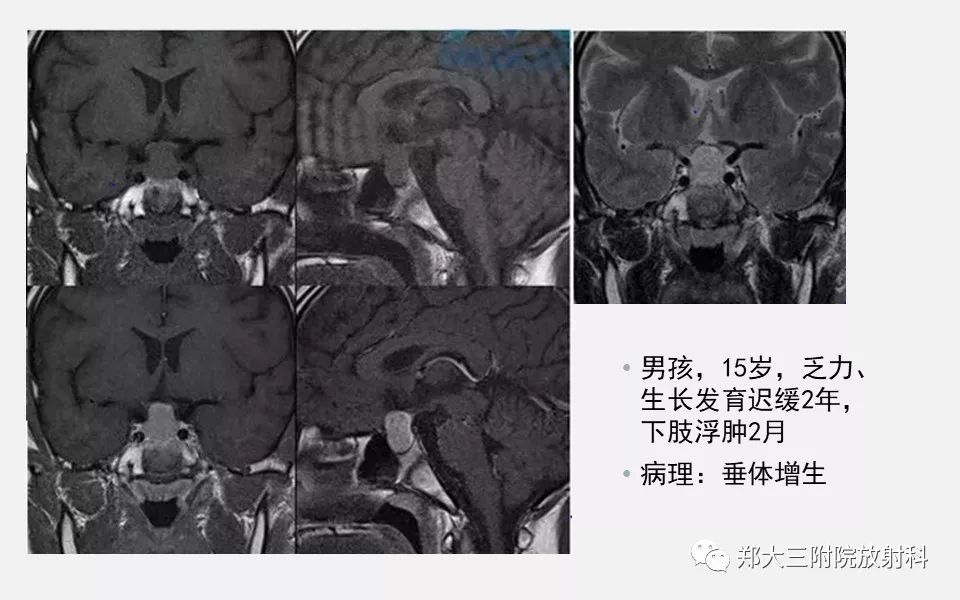 【PPT】垂体增生的影像表现