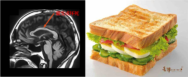 胼胝体变性的MR影像