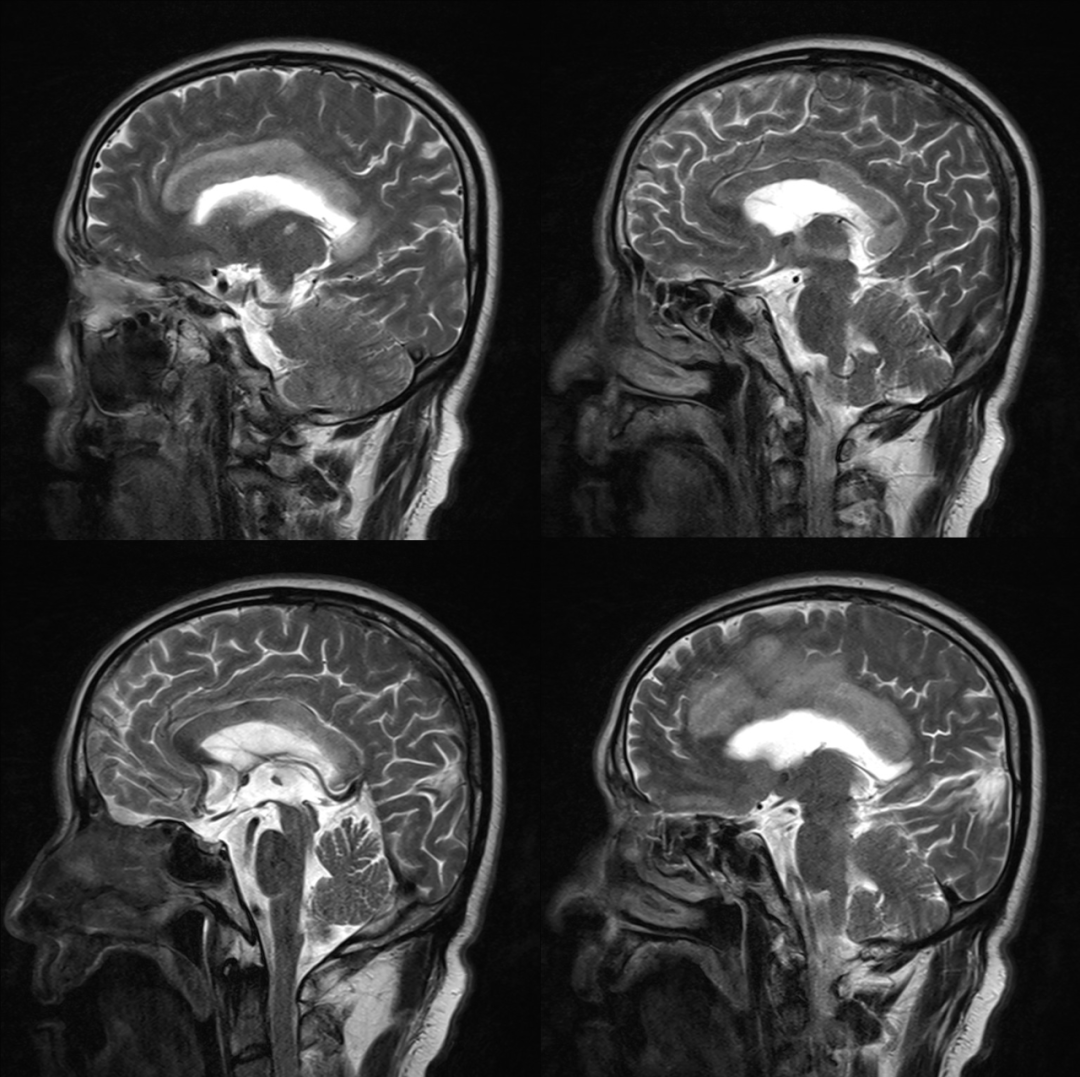 胼胝体变性的MR影像