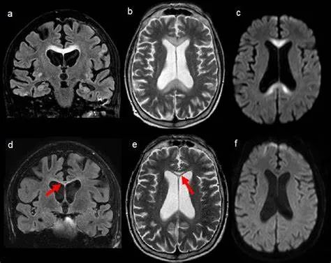 胼胝体变性的MR影像
