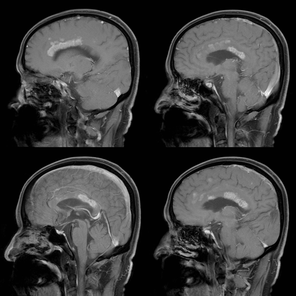 胼胝体变性的MR影像