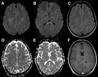 胼胝体变性的MR影像