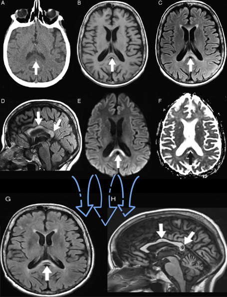 胼胝体变性的MR影像