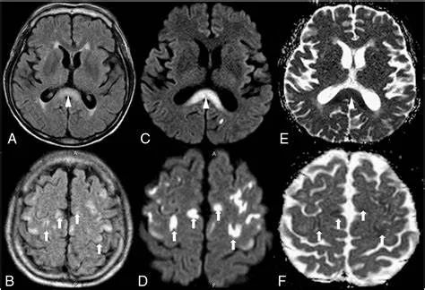 胼胝体变性的MR影像