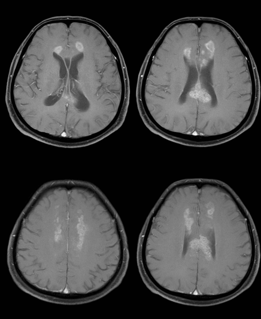 胼胝体变性的MR影像