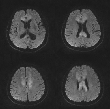 胼胝体变性的MR影像