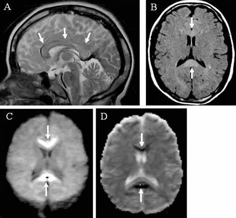 胼胝体变性的MR影像