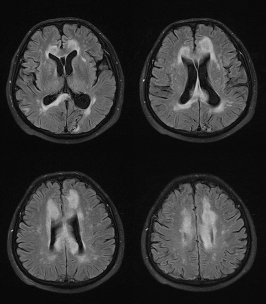 胼胝体变性的MR影像