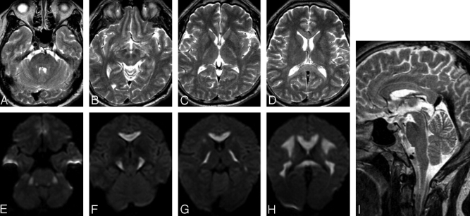 胼胝体变性的MR影像