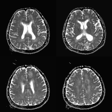 胼胝体变性的MR影像