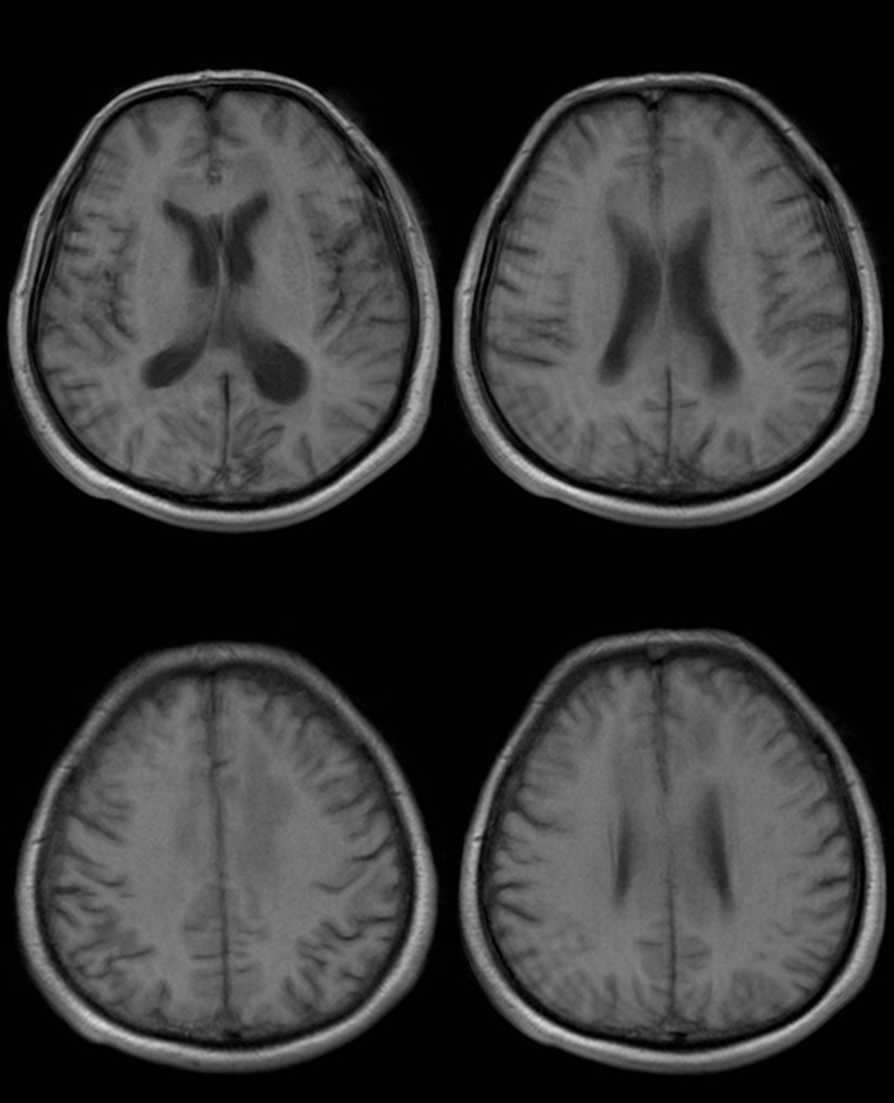 胼胝体变性的MR影像