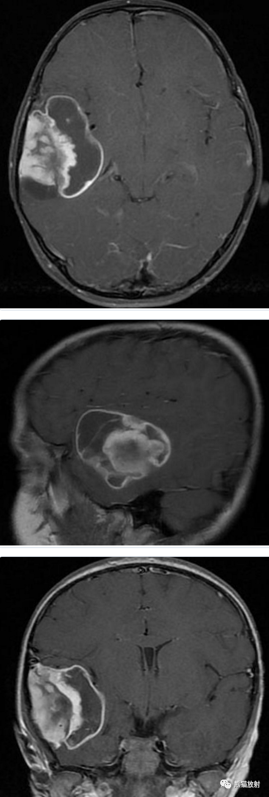 【病例】多形性黄色星形细胞瘤1例MR影像
