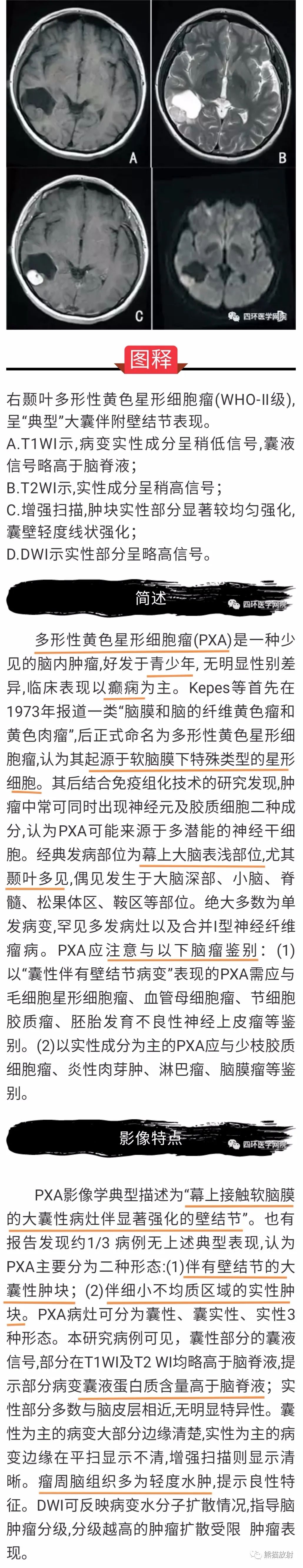 【病例】多形性黄色星形细胞瘤1例MR影像