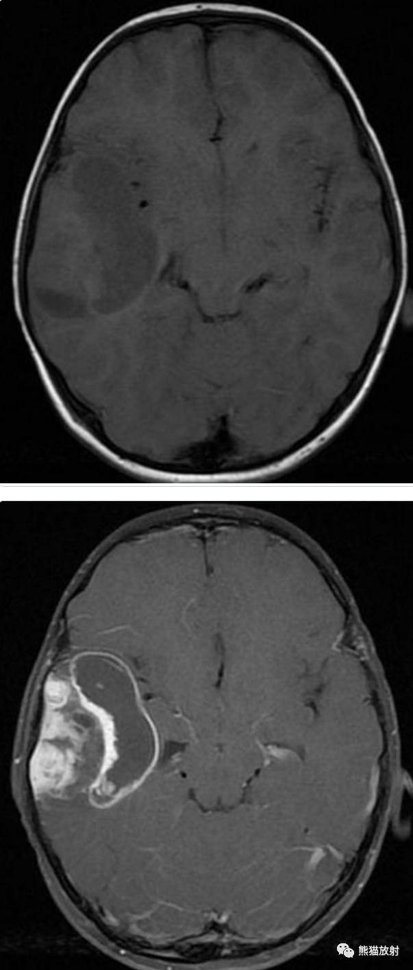 【病例】多形性黄色星形细胞瘤1例MR影像
