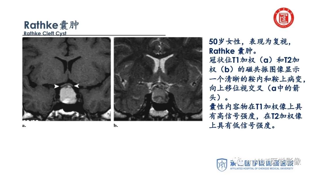【PPT】下丘脑疾病的磁共振诊断