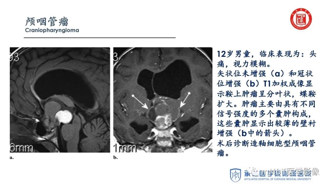 【PPT】下丘脑疾病的磁共振诊断