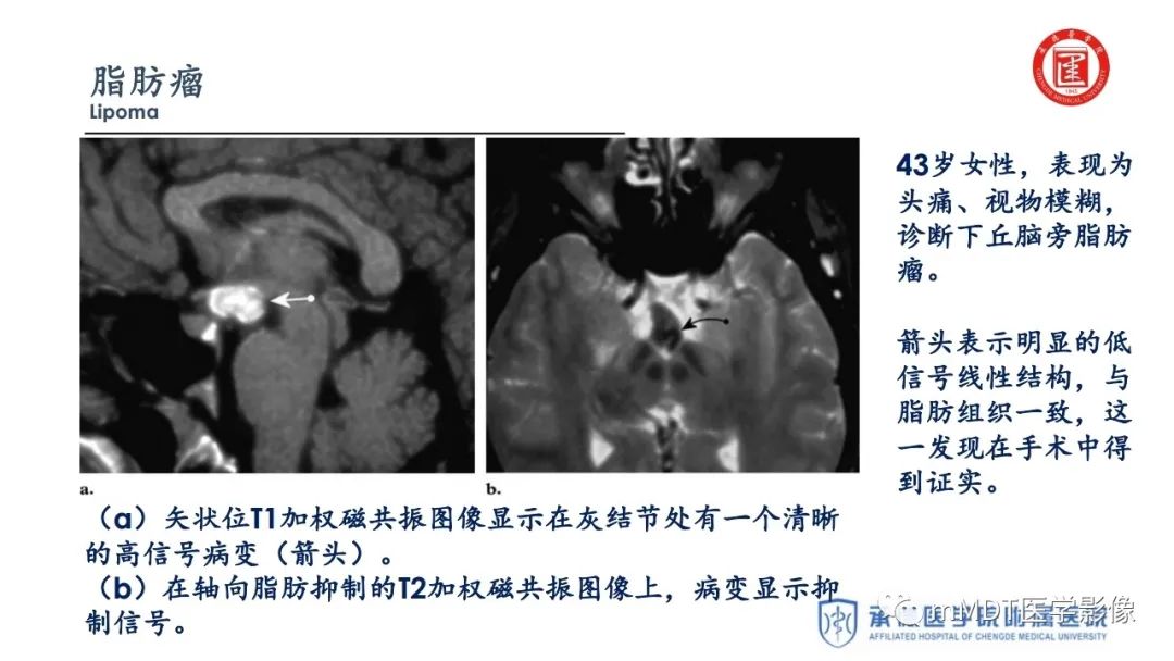 【PPT】下丘脑疾病的磁共振诊断