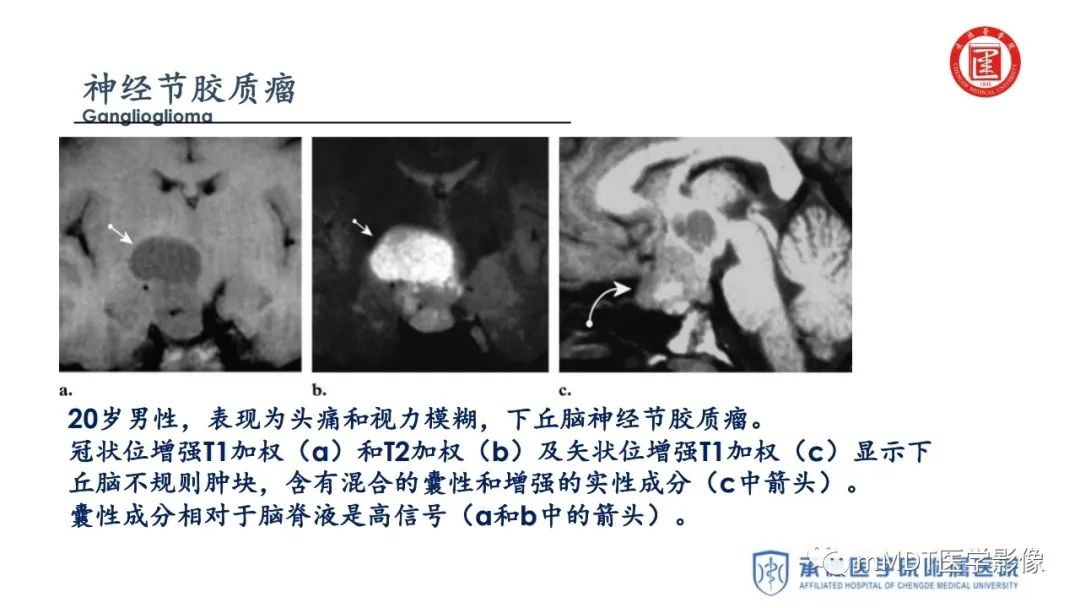 【PPT】下丘脑疾病的磁共振诊断