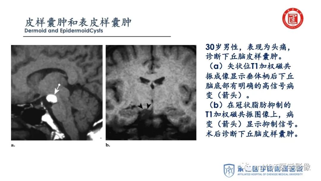 【PPT】下丘脑疾病的磁共振诊断