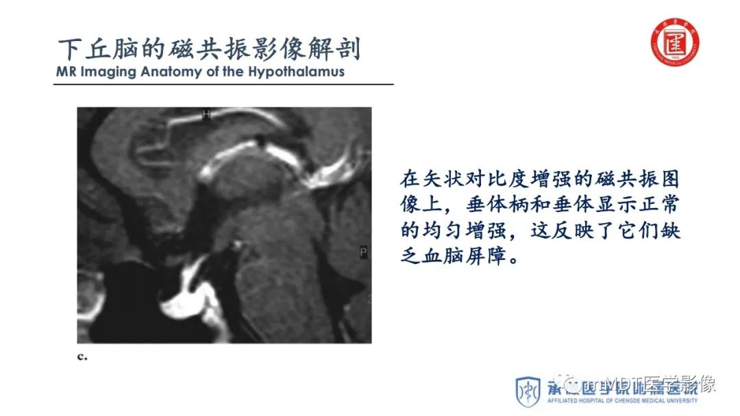 【PPT】下丘脑疾病的磁共振诊断
