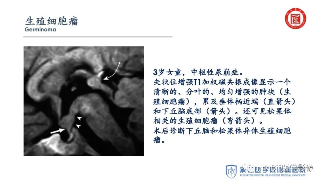 【PPT】下丘脑疾病的磁共振诊断