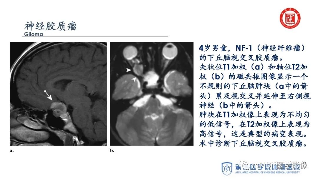 【PPT】下丘脑疾病的磁共振诊断