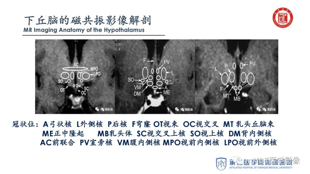 【PPT】下丘脑疾病的磁共振诊断