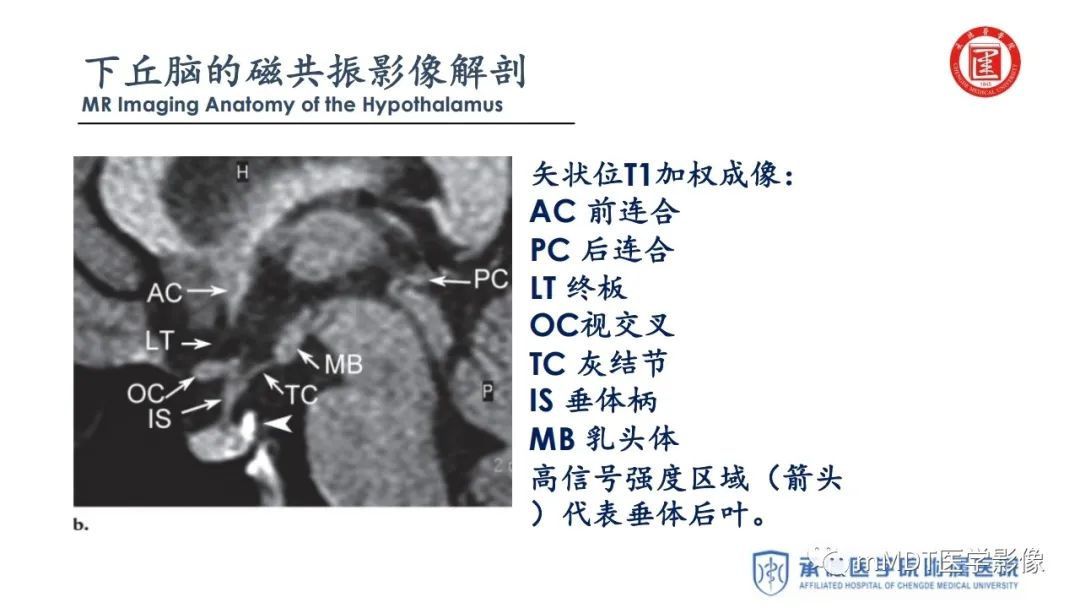 【PPT】下丘脑疾病的磁共振诊断