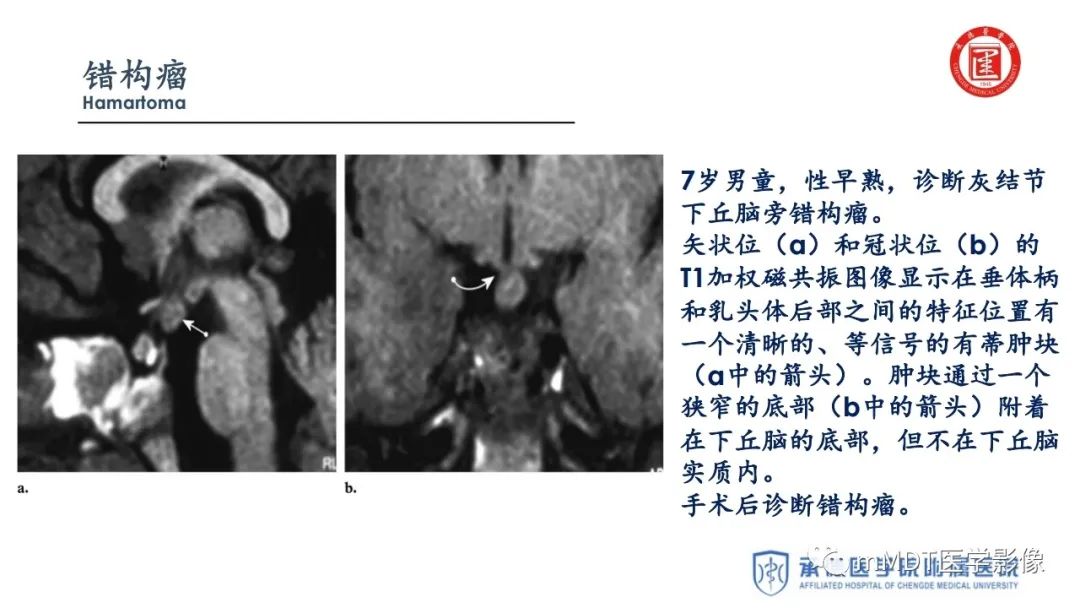 【PPT】下丘脑疾病的磁共振诊断