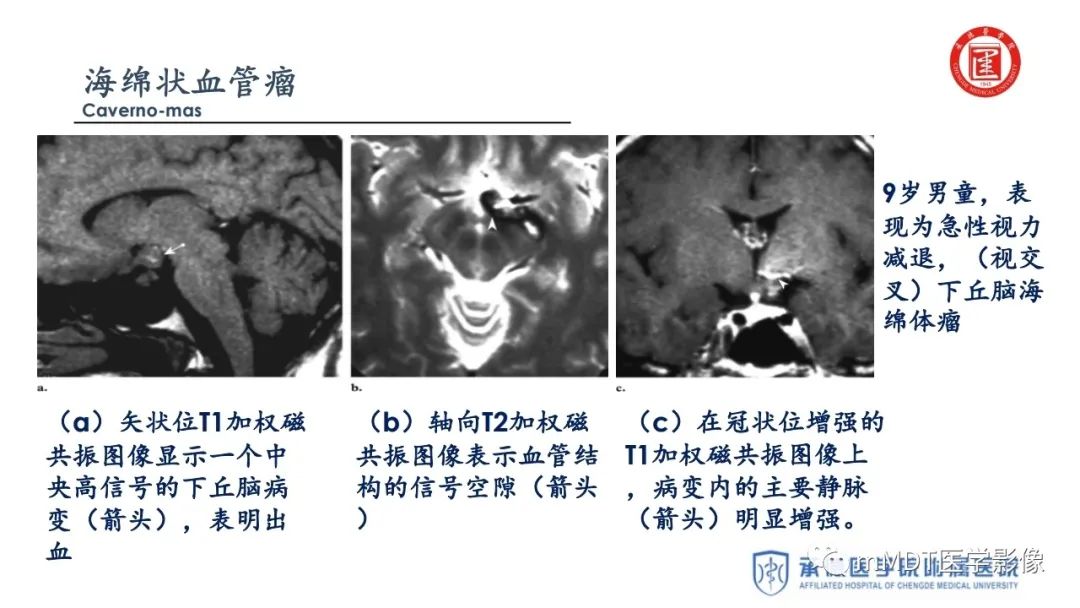 【PPT】下丘脑疾病的磁共振诊断