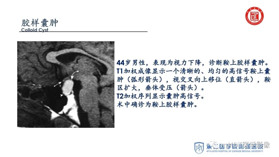 【PPT】下丘脑疾病的磁共振诊断