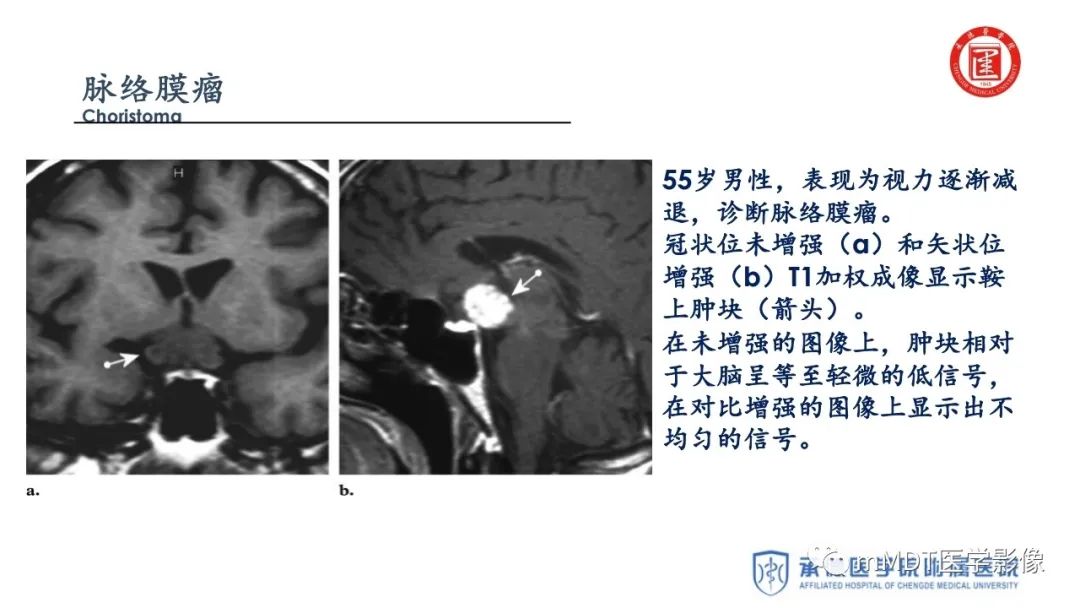 【PPT】下丘脑疾病的磁共振诊断