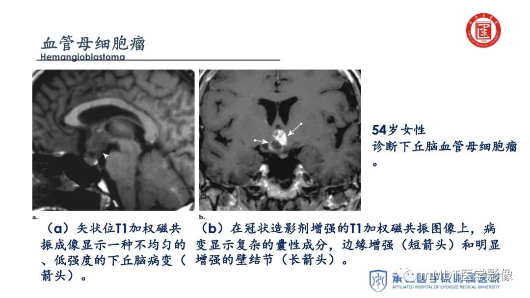 【PPT】下丘脑疾病的磁共振诊断