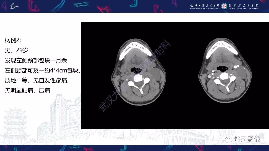 【PPT】咽旁间隙解剖及病变影像诊断