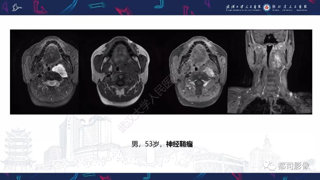 【PPT】咽旁间隙解剖及病变影像诊断